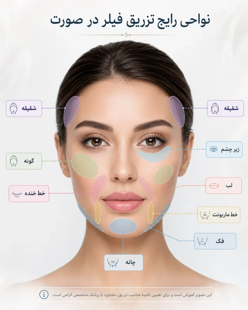 نواحی تزریق فیلر در صورت