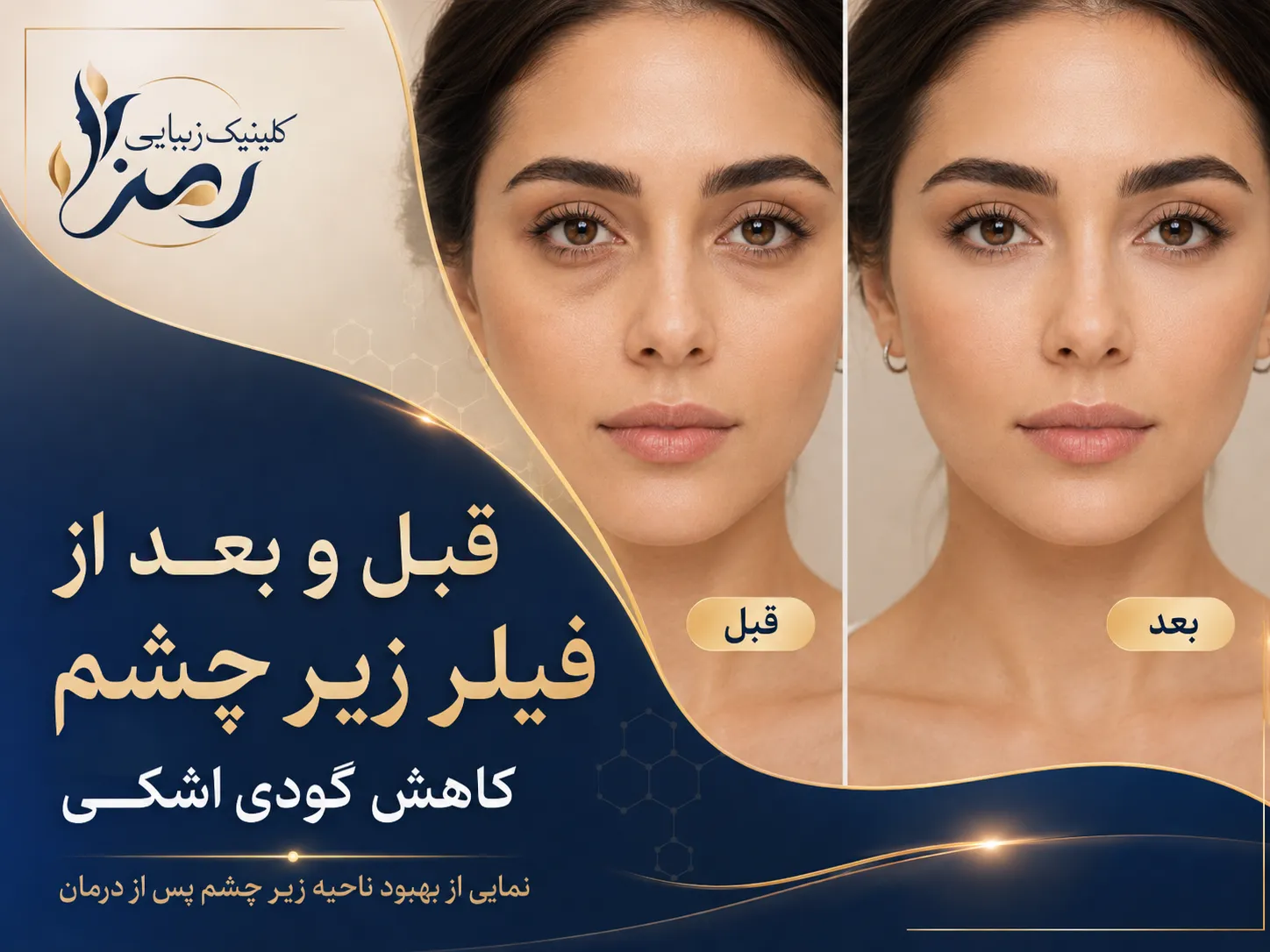 قبل و بعد از تزریق فیلر زیر چشم