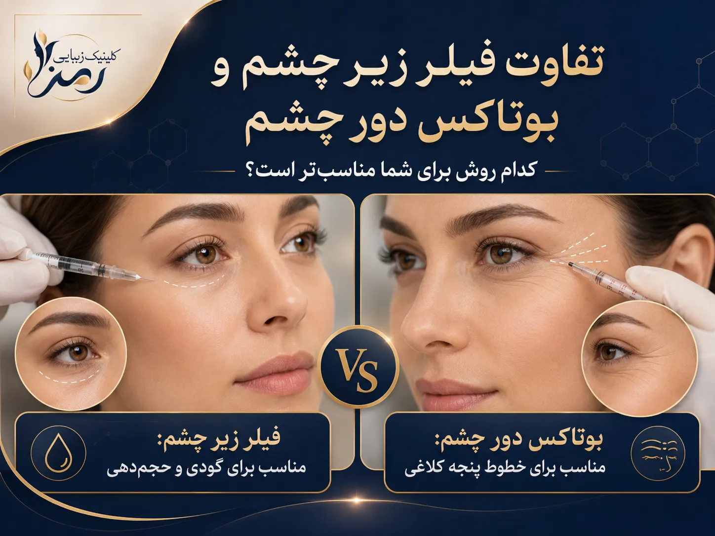تفاوت فیلر زیر چشم و بوتاکس دور چشم